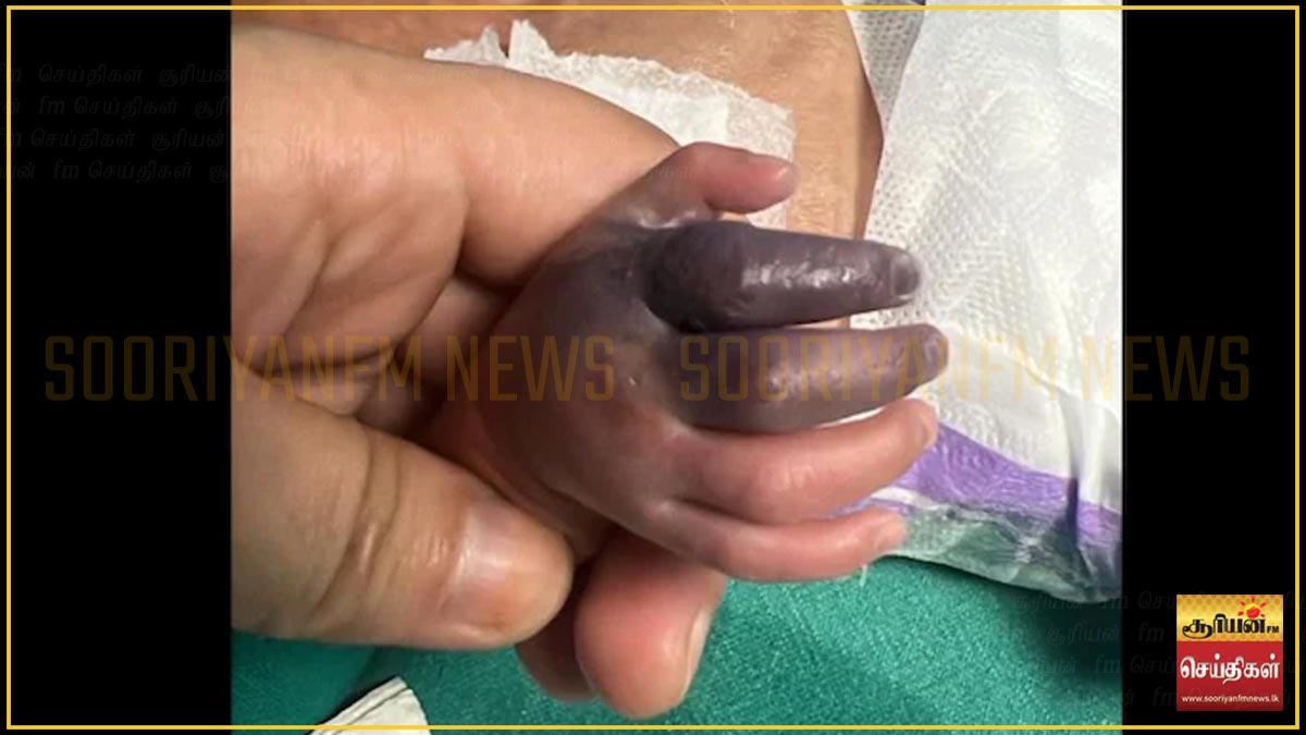 பச்சிளம் குழந்தையின் கை அகற்றப்படும் நிலையில்: மருத்துவம் அலட்சியம் காரணமா?