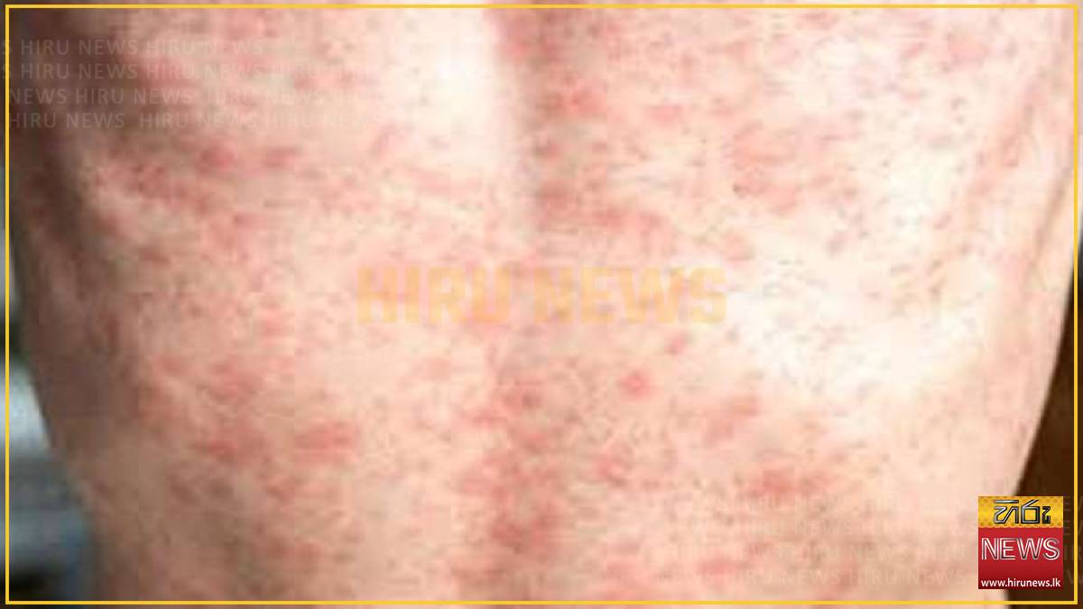 Health authorities order immediate reporting of suspected measles cases