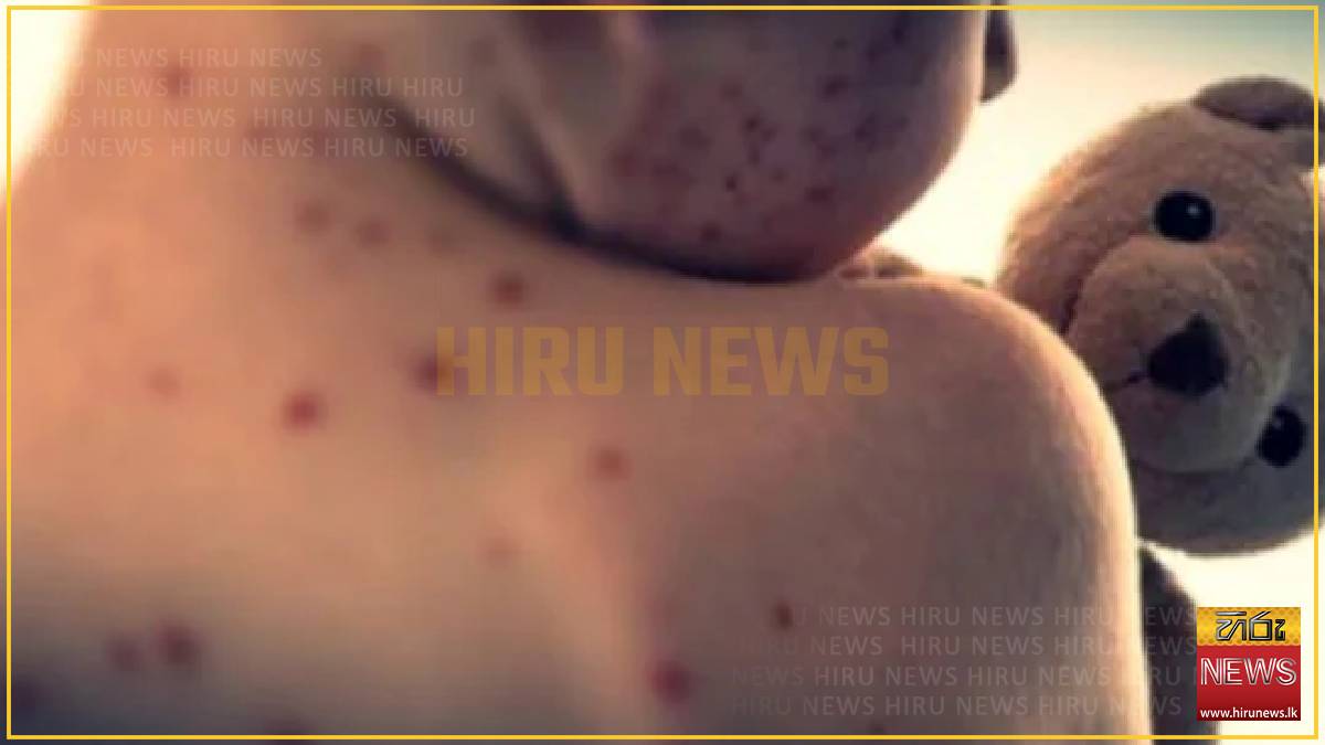 Death toll of measles outbreak in Bangladesh rise to 610