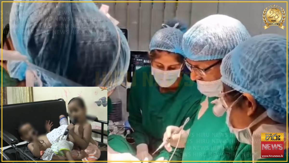 Conjoined twins successfully separated in historic surgery