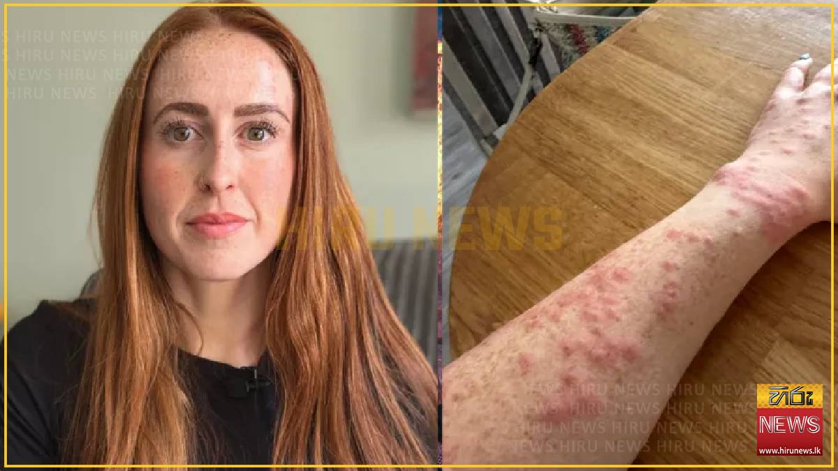 Woman attacked by bed bugs during Travelodge stay