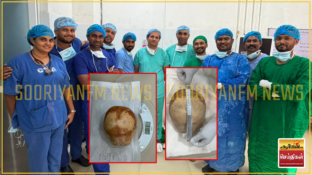 திருகோணமலையில் அகற்றப்பட்ட 3.1 கிலோ எடையுள்ள சிறுநீரகக் கல் உலக சாதனையாகப் பதிவாக வாய்ப்பு