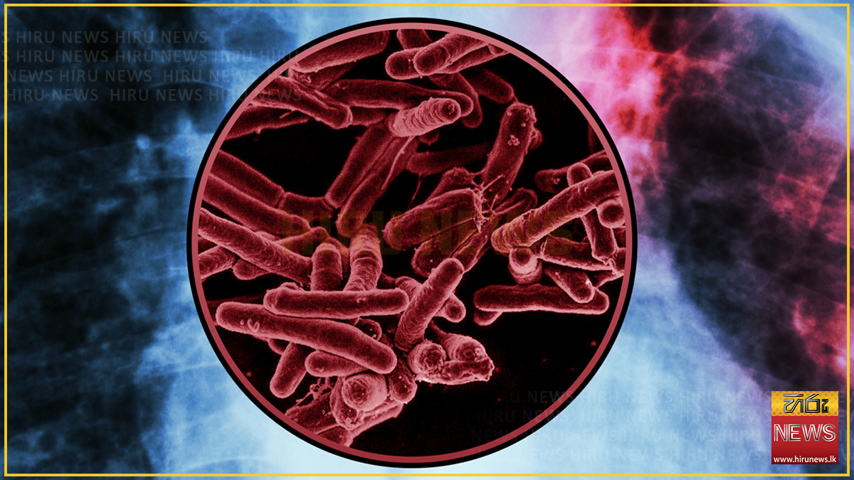 High population density in Colombo drives surge in tuberculosis cases